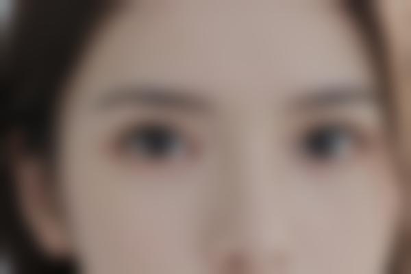 石家庄静萍胎记疤痕修复可靠，静萍医生诊疗价格透明显著！