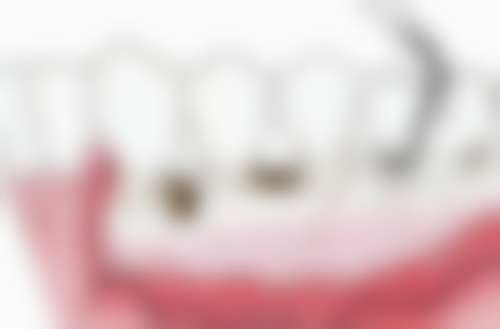 汕尾牙喜士口腔拔上颌正位简单智齿 239 元起，经验医生操作创伤小复原快 