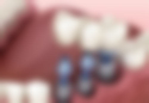 四、余姚圣亚口腔医院特色项目