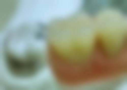 牙疼可以直接根管治疗吗？这得看情况，牙髓炎等或可行，其他病因则未必！ 