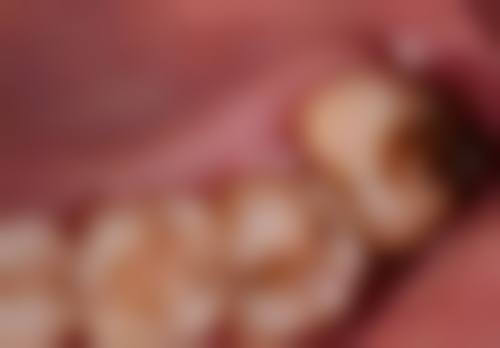 补牙之后牙还会疼吗？疾病因素同样不可忽视