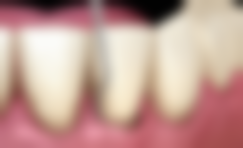 补牙之后牙还会疼吗？可能会，正常现象、非疾病与疾病因素等多种原因或致疼痛！ 