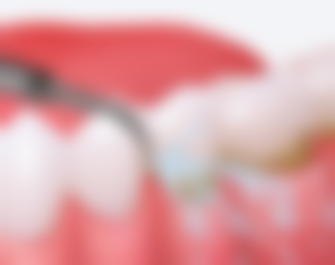 影响种植牙寿命的因素