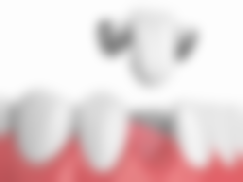 补牙的注意事项