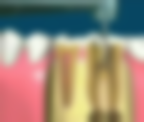 地包天牙齿还能矫正吗？不同年龄段都有办法，儿童干预佳，成人也可行但需多留意！ 