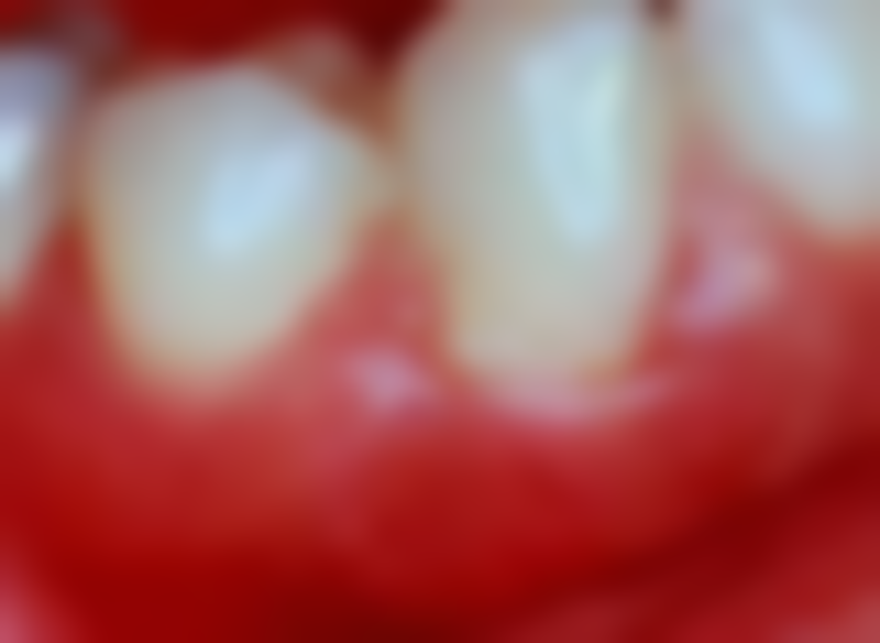 掉了牙可以种植牙吗——影响种植牙的关键因素