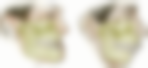 专精评估是拔牙安心的保护