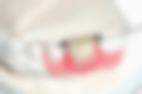 做完根管治疗需要补牙吗？答案是肯定的，补牙可增强稳固性恢复功能，好处多多！ 