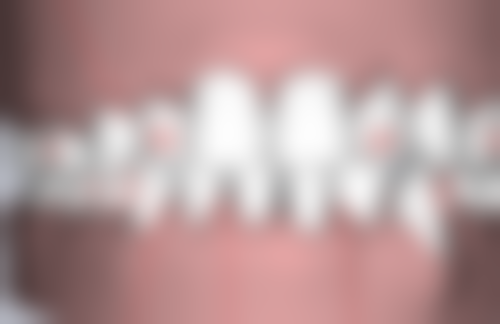 全口牙缺失的窘境与对策