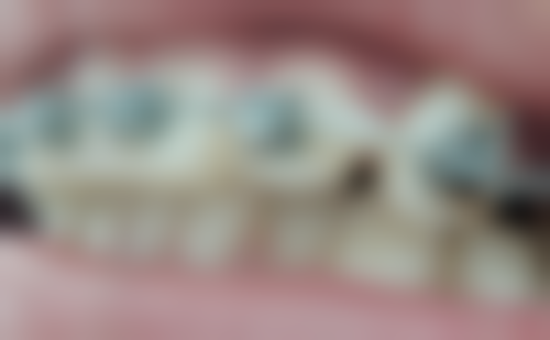 口腔扁平苔藓能做烤瓷牙吗？需综合病情、口腔状况等因素评估，建议咨询专业医生！ 