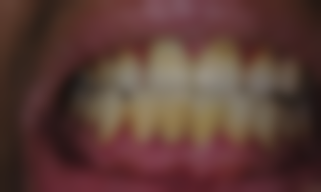 80岁老人种植牙，多方面因素综合考量