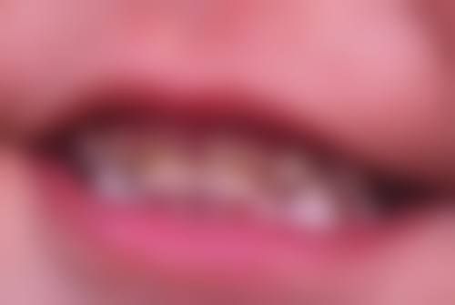 小孩子矫正牙齿要拔牙对身体有伤害吗？一般无大碍，但有风险，选好医生做好护理可降低！ 