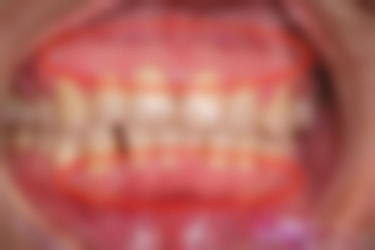 洞型对树脂补牙使用时长的影响