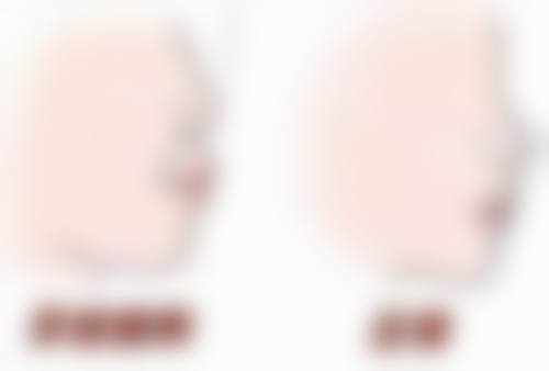 深覆合不拔牙可以矫正吗？这要分情况，轻度或颌骨空间足一般无需拔牙，严重者可能要拔！ 