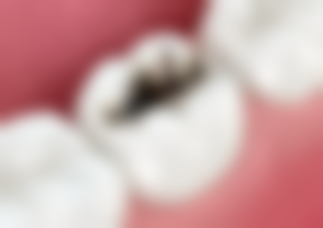 非急症情况建议产后补牙