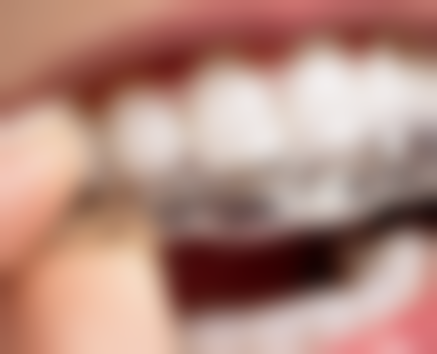 什么情况不能根管治疗只能拔牙——牙齿折裂重度