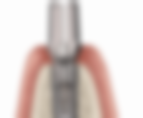 门牙烤瓷牙套能用多久？受材料、使用、维护等多因素影响，一般5 - 10年甚至更久！ 