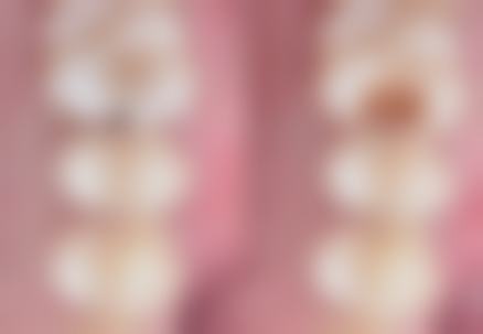 做完根管治疗会牙疼吗？正常轻微疼痛属术后反应，异常疼痛或因治疗不彻底等原因！ 