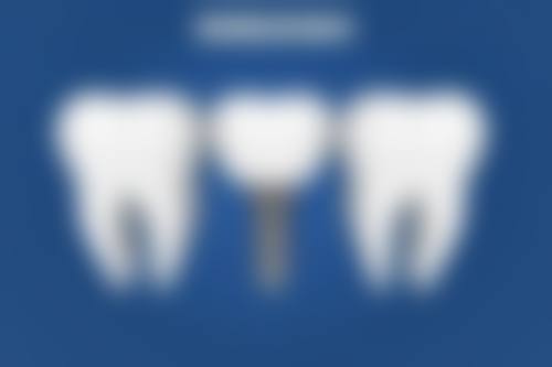 不同补牙材料的护理要点