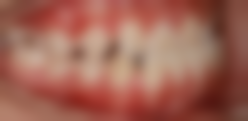 应对根管治疗后牙龈出血的方法