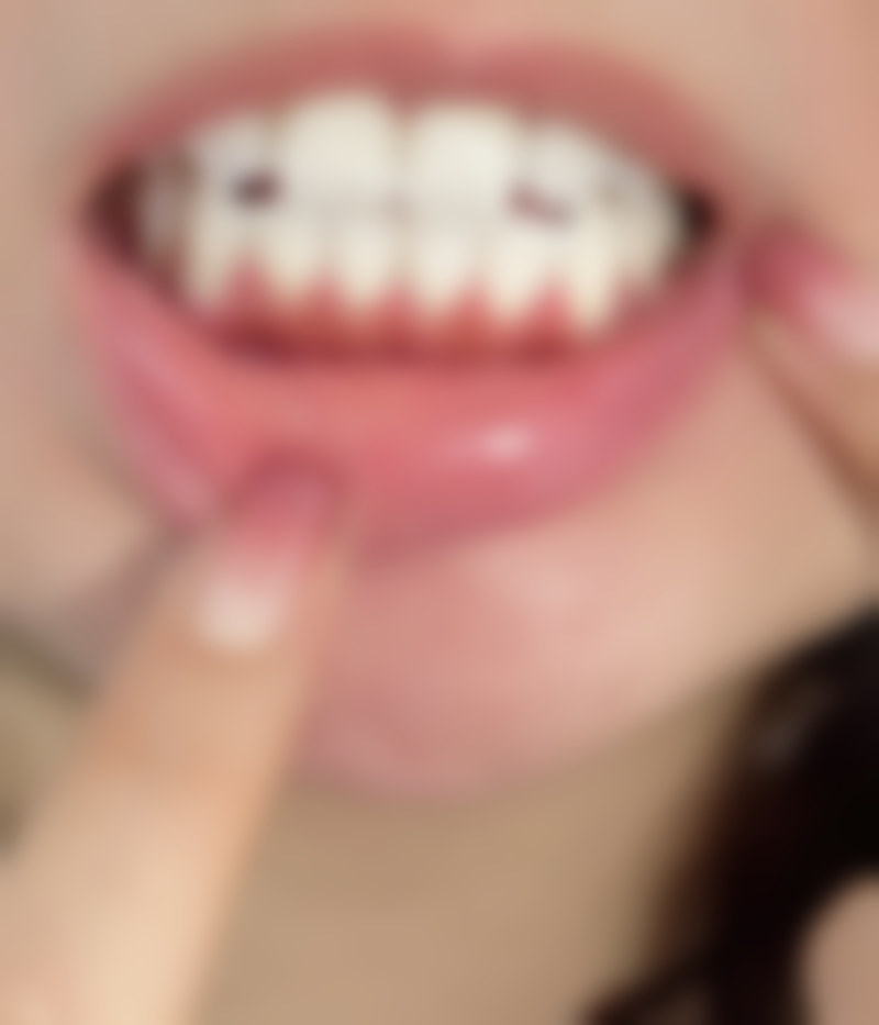 第二次补牙：消炎与进一步处理