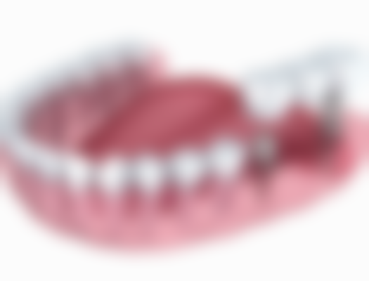 如何判断是否需要拔牙