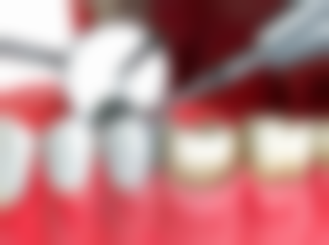 拔牙后疼痛异常的情况