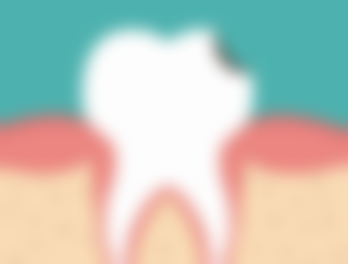 龋深或根管治疗后可考虑做烤瓷牙