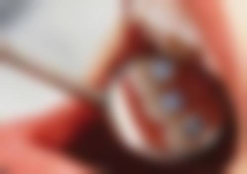 补牙有牙结石会给洗牙吗？这得看口腔状况，医生会据此选治疗方案！ 