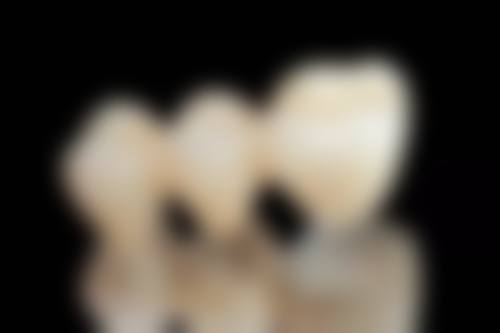 烤瓷牙冠怎么取下来？常用取冠器、车针等工具，还有多种拆除方式，需专业医生操作！ 