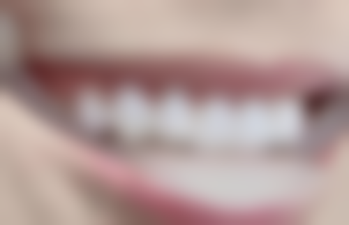 影响拔牙切开牙龈愈合时间的因素