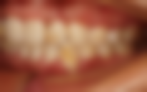 拔牙前后的注意事项