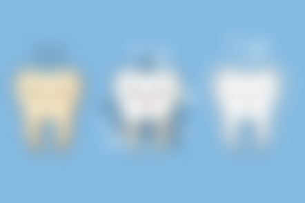 评估门牙做种植牙的牙槽骨条件