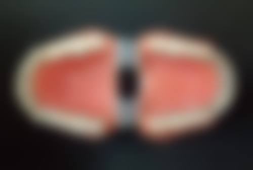 购买百万医疗险的注意事项