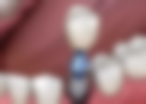 百万医疗补牙能报销吗？一般美容补牙难报销，意外致损可报，购险注意多方面！ 