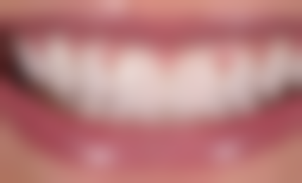 固定活动义齿的优劣势