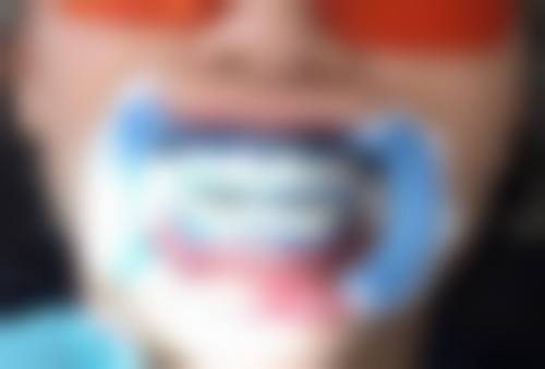 蛀牙疼可以做根管治疗吗？不同类型蛀牙疼痛处理不同，部分情况可做，流程及注意事项揭秘！ 