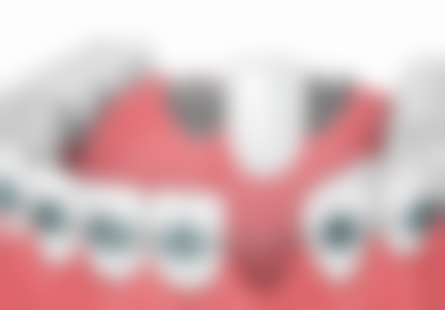 一般拔牙后多久可以种？多数3 - 6个月，特殊情况各异，快来了解不同种植时机！ 