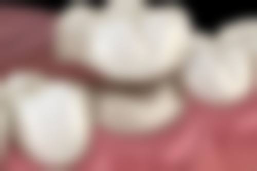 如何缓解补牙后的疼痛