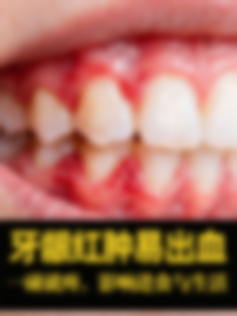 拔牙后没有漱口水用什么代替？24小时内用唾液，24小时后可用清水或淡盐水轻柔漱口！ 