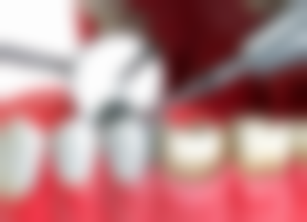 术后护理：巩固补牙成果