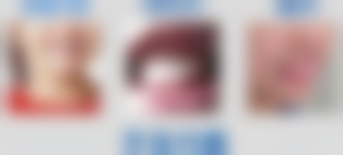 哪些类型的地包天难以自愈需要干预