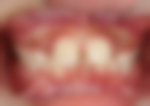 操作不当造成的牙龈出血