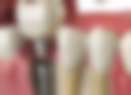 五、杭州美莱口腔王雷医生技术怎么样？