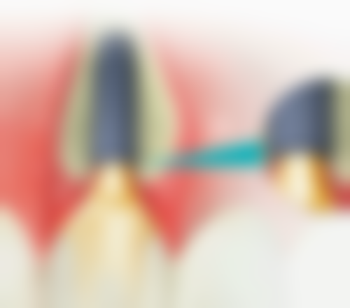 打桩的好处和不打桩的情况