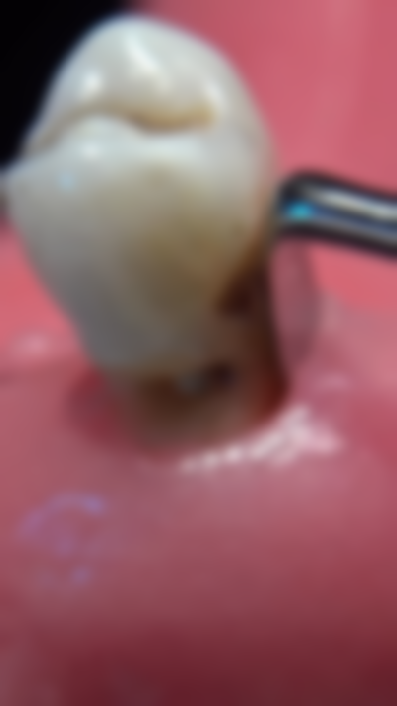 哪个国家的种植牙好一点？韩、瑞、德、以等各有优势，结合预算和口腔状况选才对！ 