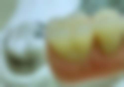 几乎看不到牙结石需要洗牙吗？即便难察觉，牙结石仍可能存在，洗牙有必要，专业建议来解答！ 