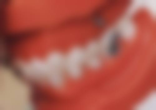 半口种植牙要花多长时间？受口腔、全身状况等影响，常规3 - 6个月，复杂情况更久！ 