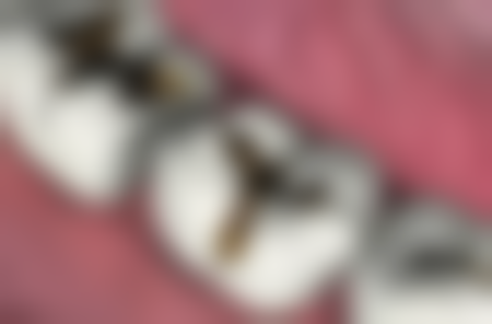 四环素牙有牙结石能洗牙吗？可以，但要选正规机构，洗牙时控功率，避免损伤牙釉质！ 