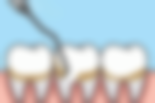 谨慎权衡八十多岁老人拔牙的利弊